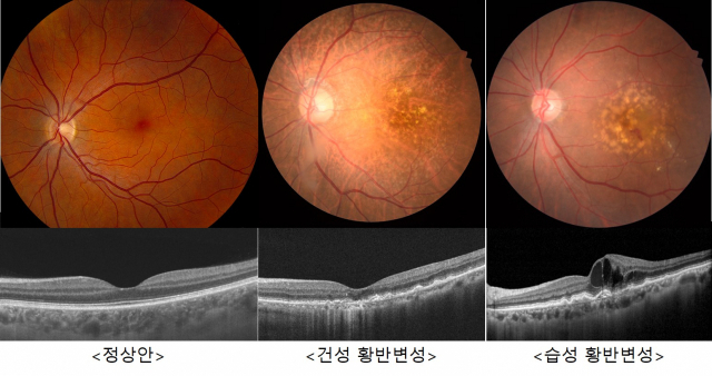 (왼쪽부터)질병이 없는 정상 눈, 건성 황반변성, 습성 황반변성의 안저 촬영 사진. 사진 제공=세브란스병원