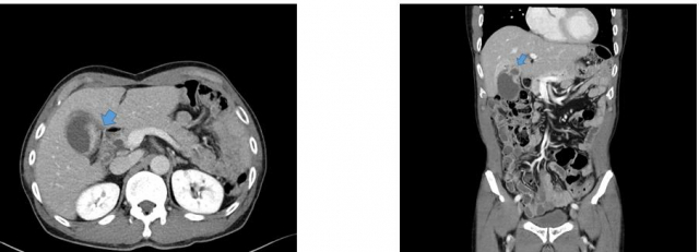 환자의 컴퓨터단층촬영(CT) 검사 결과 담낭암(파란색 화살표)이 관찰된다. 사진 제공=서울성모병원