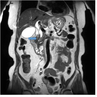 환자의 자가공명영상(MRI) 검사 결과 담관암(파란색 화살표)이 관찰된다. 사진 제공=서울성모병원