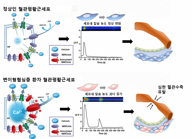 혈관 평활근세포의 정상 수축기전(위쪽)과 변이성 협심증 환자의 과도한 수축기전 비교. 사진 제공=서울대병원