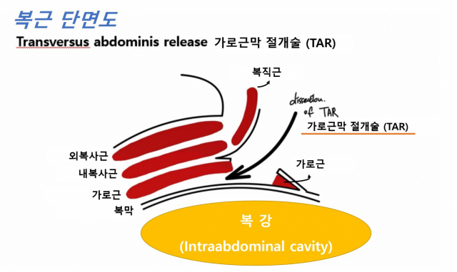 복벽 재건을 위해 복벽의 3개의 근육층 가운데 가장 안쪽에 위치한 가로근을 절개한 가로근막 절개술. 사진 제공=서울성모병원