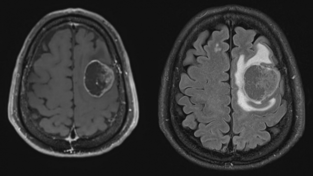 우측 편마비와 언어장애를 호소하는 환자에게 조영증감 MRI 검사를 시행한 결과 뇌전이암이 확인됐다. 전이암 주변으로 종양으로 의심되는 덩어리(왼쪽)와 부종이 관찰된다. 사진 제공=서울성모병원