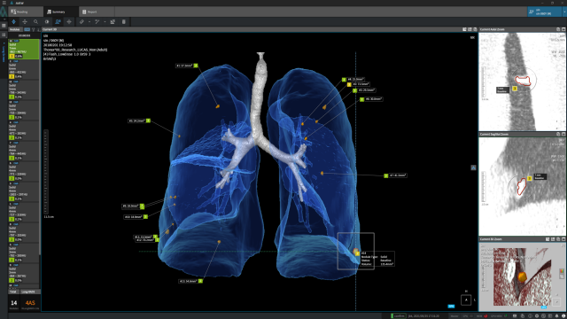 AI 기반 흉부 진단 솔루션 '에이뷰 엘씨에스 플러스(AVIEW LCS PLUS)' 작동 화면. 사진 제공=코어라인소프트