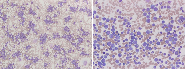 만성 골수성 백혈병 환자의 현미경 사진. 말초혈액(왼쪽)과 골수에서 다양한 단계의 골수구계 혈액암 세포가 관찰된다. 사진 제공=서울성모병원