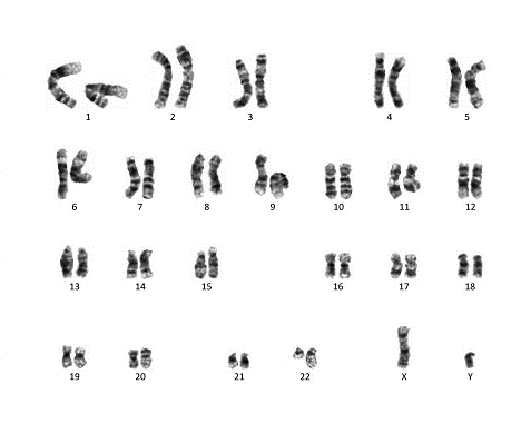 만성 골수성 백혈병에서 관찰되는 '22번 염색체의 끝부분에 9번 염색체의 절단된 부분이 결합하면서 생기는 필라델피아 염색체' 소견. 사진 제공=서울성모병원