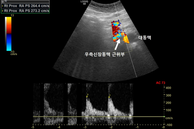 갑작스럽게 고혈압 조절이 되지 않는 환자에게 도플러 초음파 검사를 시행한 결과 오른쪽 신장동맥 근위부의 혈류 속도가 200cm/sec 이상까지 증가됨을 관찰할 수 있다. 사진 제공=서울성모병원