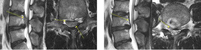 허리디스크 환자의 수술 전후 MRI 검사 결과. 수술 전 검게 보였던 디스크(노란색 화살표) 부분이 수술 치료를 통해 호전되어 밝아졌다. 사진 제공=분당서울대병원