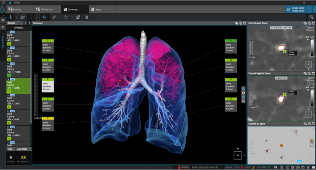 AI 기반 폐결절 자동 분석 설루션 ‘에이뷰 엘씨에스 플러스(AVIEW LCS PLUS)' 작동 화면. 사진 제공=코어라인소프트
