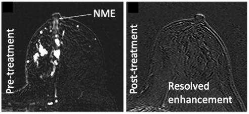 유방암 환자의 유방 MRI 검사에서 선행항암요법 전(왼쪽)에 관찰되던 ‘비종괴성 조영 증강’ 소견이 항암요법 후 사라진 것을 확인할 수 있다. 사진 제공=강남세브란스병원