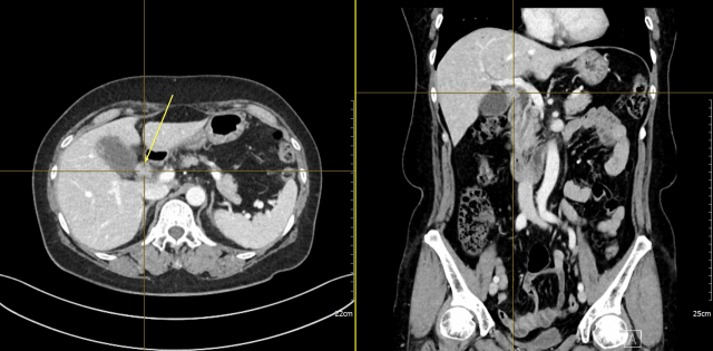 컴퓨터단층촬영(CT) 검사 결과 담낭암(노란색 화살표) 소견이 관찰됐다. 사진 제공=분당서울대병원