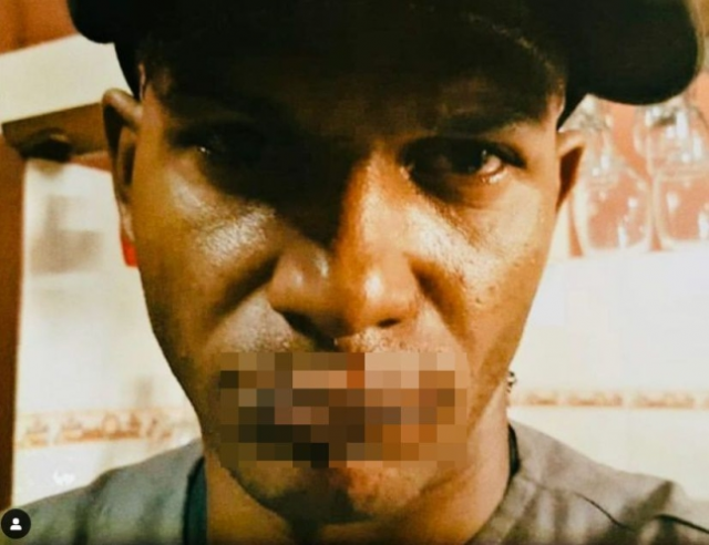 쿠바에서 반체제 활동을 벌였다가 실형을 받은 한 래퍼가 수감 생활 중 받은 학대에 대한 저항의 뜻으로 자기 위·아래 입술을 꿰매 붙이는 사건이 발생했다. 인스타그램 캡처(@maykelosorbo)
