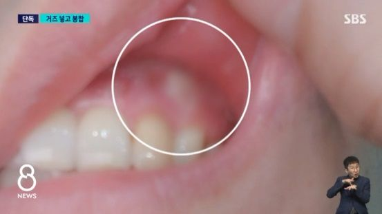 충남 천안의 한 대학교 치과병원에서 수술 받은 환자의 잇몸에서 거즈가 발견됐다. 사진=SBS 보도화면 캡처