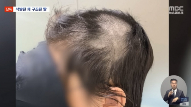 남자친구에게 강제로 머리를 삭발당한 피해 여성의 모습. MBC 보도화면 캡처