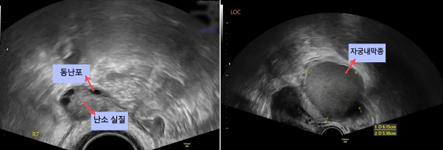 질환이 없는 정상인(왼쪽)의 초음파 영상에서 동난포(미성숙난포검정색 음영)와 난소 실질이 관찰된다. 반면 자궁내막종 환자(오른쪽)는 초음파 영상에서 정상 난소 실질이 파괴되어 보이지 않고 약 6cm 크기의 자궁내막종이 관찰된다. 사진 제공=서울대병원