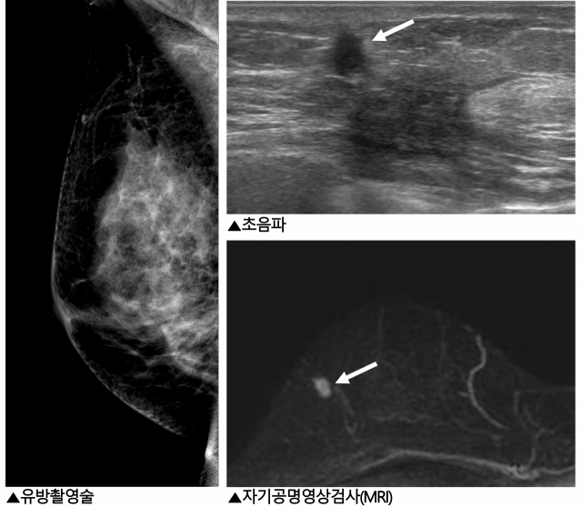 호르몬 양성 HER-2 음성 유방암으로 수술을 받은 35세 여성 환자에게 2년 3개월 후 유방 초음파(오른쪽 위)와 자기공명영상검사(MRI·오른쪽 아래)를 시행한 결과, 유방 수술 부위 근처에 5mm 크기의 불규칙한 종괴(화살표)가 관찰되어 재발 소견을 보였다. 다만 치밀유방과 수술 후 반흔으로 인해 유방촬영술(왼쪽)에서는 종괴가 보이지 않았다. 사진 제공=서울대병원