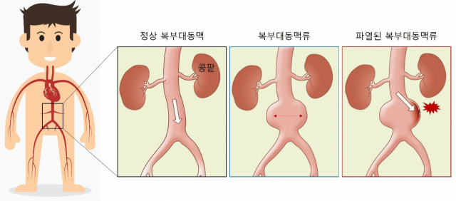 터지면 절반이 사망…'배 속 시한폭탄' 조기에 잡으려면 ‘이 방법’ 뿐[건강 팁]