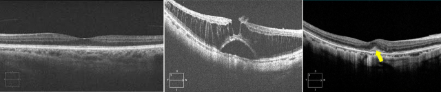 정상 눈과 고도근시가 발생한 눈의 망막층간분리 현상, 고도근시가 발생한 눈에 형성된 신생혈관을 관찰할 수 있다. 사진 제공=서울대병원