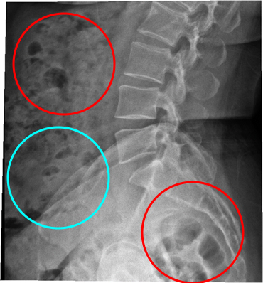 엑스레이 사진에서 보이는 검은 것(빨간 원)은 ‘가스’, 하얀 덩어리(파란 원)들은 대변이다.