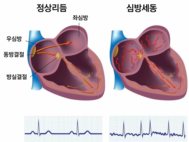 정상리듬(왼쪽)과 심방세동 발생 시 심장 모식도와 심전도 소견. 사진 제공=서울대병원