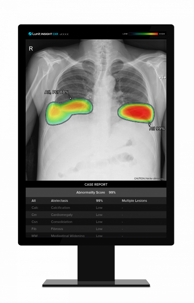 루닛 인사이트 CXR. 사진 제공=루닛