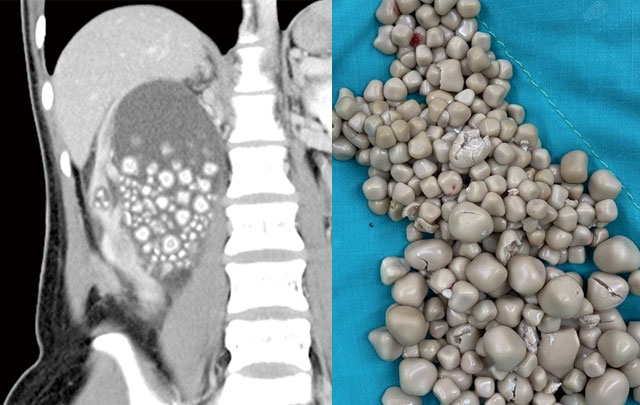 평소 물 대신 주스만 마셨던 여성의 엑스레이 촬영 사진(왼쪽)과 여성의 신장에서 나온 결석들. 사진= 치메이병원·타이완뉴스