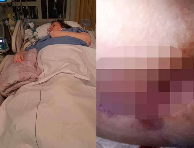 네덜란드의 59세 여성 트레이시 에글린이 병원에 입원해 치료를 받았다(왼쪽). 괴사성 근막염으로 엉덩이가 감염된 환자의 모습. 뉴욕포스트·더 미러