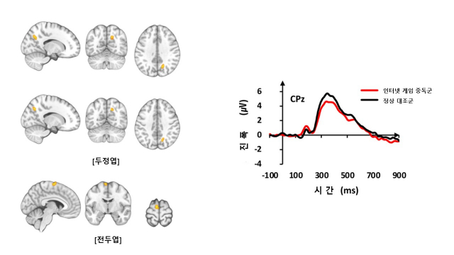 인터넷게임 중독군과 정상 대조군의 기능적 MRI(왼쪽)와 뇌파검사 결과. 사진 제공=삼성서울병원