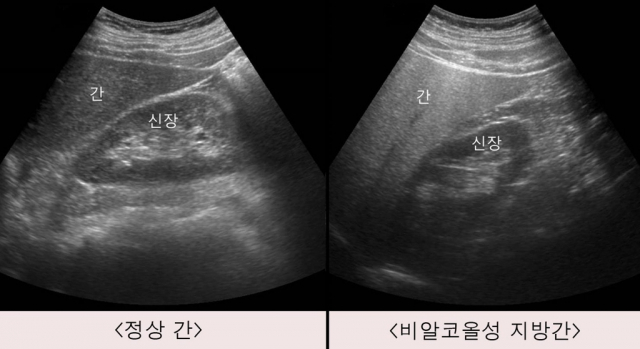 '13㎏ 감량' 성공한 강남, 몸 '이곳'도 좋아졌다는데…의사도 '획기적' [셀럽의 헬스]