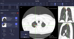 뷰노, AI 기반 흉부 CT 판독 솔루션 일본서 보험 급여 적용