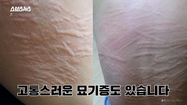 피부묘기증이 피부에 드러난 증상. SBS 방송화면 캡처