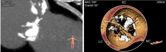 타비시술 전 이모 씨의 심장 CT 사진(왼쪽)과 심장 CT를 재구성한 대동맥판막 사진. CT 검사에서 대동맥판막에 심한 석회화(흰색 음영)가 관찰됐고, 석회화는 좌심실 유출로(붉은색 화살표)까지 침범해 있음이 확인됐다. 또 대동맥판막 사진에서 소엽이 2개 뿐인 이엽성 대동맥판막 소견과 함께 심한 석회화(흰색 음영)가 진행돼 있는 것으로 나타났다. 사진 제공=한림대동탄성심병원