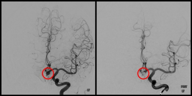 뇌동맥류 환자의 치료 전 혈관 모습과(왼쪽)과 코일색전술을 받은 뒤의 사진. 사진 제공=강릉아산병원