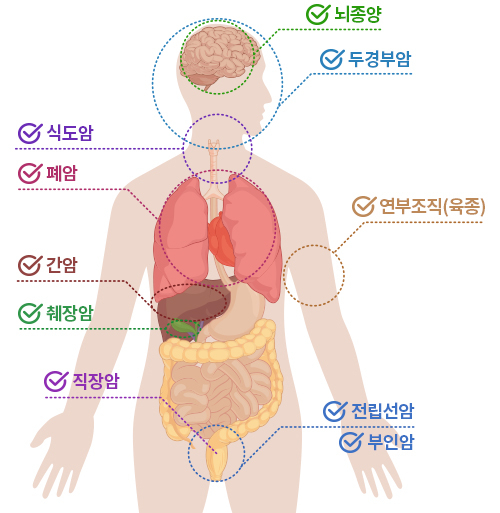 중입자치료 대상 암종. 사진 제공=서울대병원