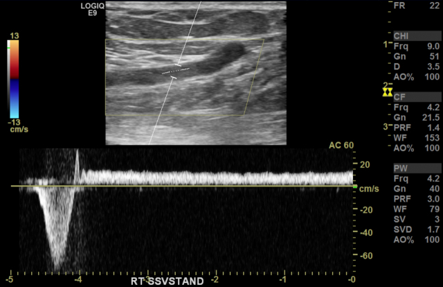 하지정맥류 환자에 실시한 초음파검사 결과, 작은 두렁정맥의 종단면에서 0.5초 이상의 역류 소견이 관찰됐다. 사진 제공=삼성서울병원