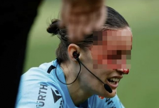카메라에 얼굴을 맞아 크게 다친 스페인 프로축구에서 여성 심판. 사진=토크스포츠