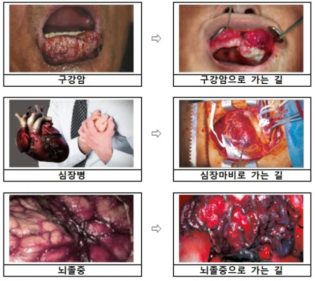 바뀌게 되는 담뱃갑 경고 그림 중 일부. 사진 제공=보건복지부