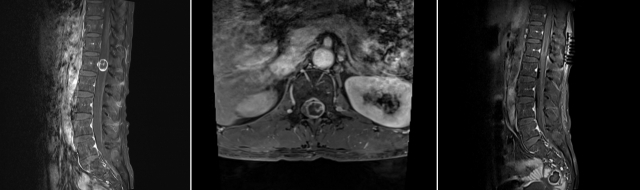 50세 척수종양 환자에게 척추자기공명영상(MRI) 검사를 시행한 결과 측면(왼쪽)과 단면(가운데) 사진에서 제1 요추 부위 척추관 내에 1.6x1.8㎝ 크기의 경막내 수외종양이 관찰된다. 수술 후 측면 사진(오른쪽)을 보면 척추관 내에서 종양이 완전히 제거된 것을 확인할 수 있다. 사진 제공=고대구로병원