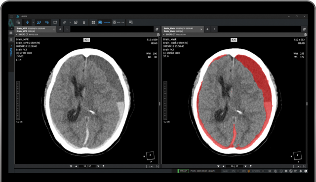 코어라인소프트의 뇌출혈 진단 보조 솔루션 ‘에이뷰 뉴로캐드’의 출혈량 자동 분석 기능. 사진 제공=코어라인소프트