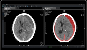 코어라인소프트 "뇌출혈 의료 AI, 16개 병원서 비급여 청구 시작"