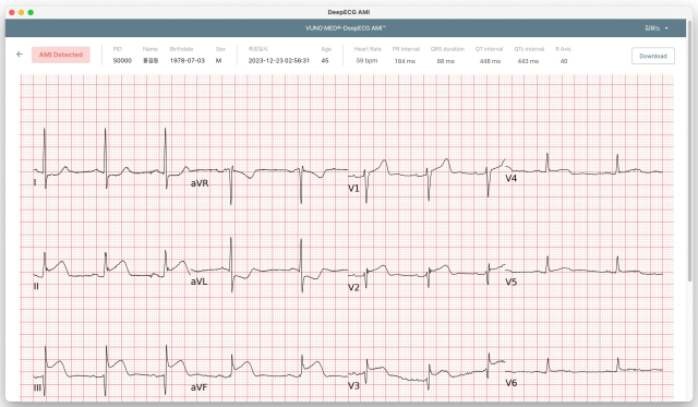 뷰노 메드 딥ECG™ AMI 운영화면 예시. 사진 제공=뷰노