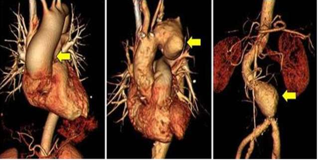 CT 검사로 대동맥류(노란색 화살표)가 관찰되는 모습. 사진 제공=삼성서울병원