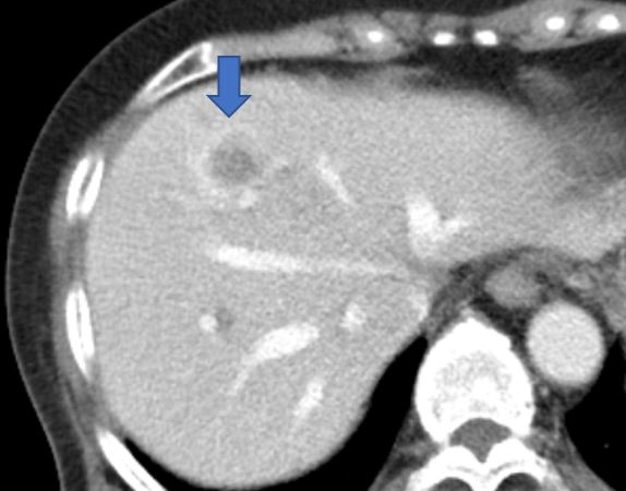 간암(파란색 화살표)이 발생한 C형간염 환자의 CT 사진. 사진 제공=고대안산병원