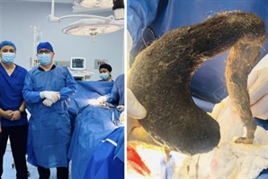 복통·구토 시달리던 20대女 뱃속에…1㎏ 달하는 ‘이것’ 나왔다 경악