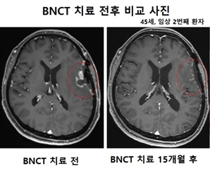 '국내 최초 A-BNCT 개발'…가천대 길병원 악성 종양 교모세포종 극복 '한 발짝'