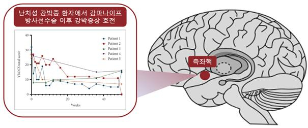 측좌핵에 시행한 감마나이프 방사선 수술 후 주별 YBOCS 점수 추세. 사진 제공=서울대병원