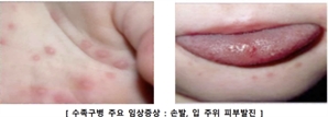 "백신 없는데 우리 아이도 걸렸다"…10년 만에 대유행 온 '이 병' 주의보