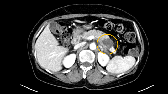 췌장암 환자의 CT 검사 결과 종양(노란색 동그라미)이 관찰된다. 사진 제공=서울아산병원