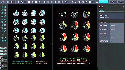 뇌 관류영상 분석 AI 솔루션 JLK-CTP. 사진제공=제이엘케이