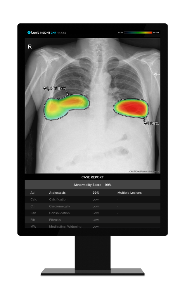 루닛 인사이트 CXR. 사진 제공=루닛