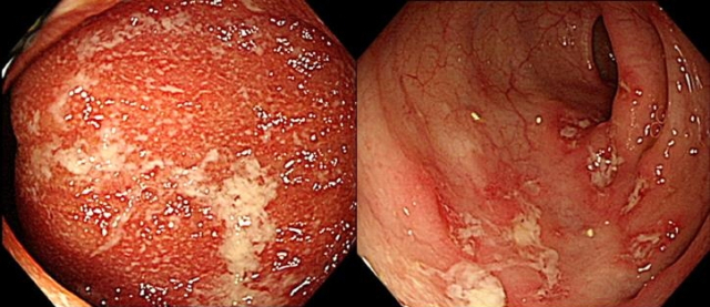 궤양성 대장염(왼쪽)과 크론병의 대장내시경 사진. 사진 제공=서울아산병원
